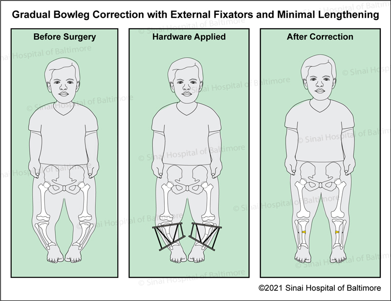 Dwarfs types of Causes And