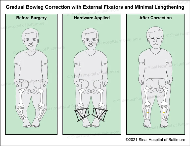 Bowed (Tibia Varus) Correction for Children with Achondroplasia Under the age of 8 to 10 Years Old Without Extensive Lengthening: Images showing anatomy before surgery, after external six-axis correction hardware is applied, and after correction with minor lengthening and hardware removed.
