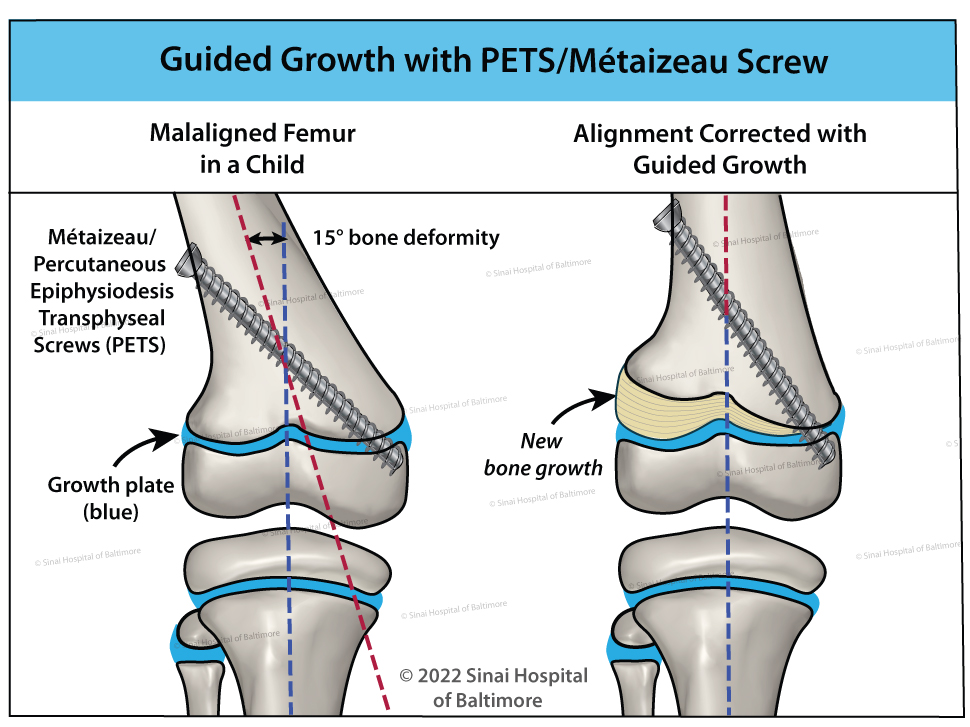 An illustration of guided growth with a Métaizeau screw in a child;'s femur