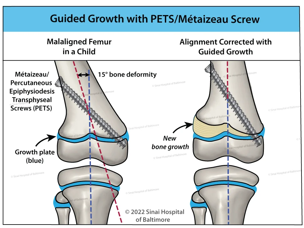 An illustration of guided growth with a Métaizeau screw in a child;'s femur