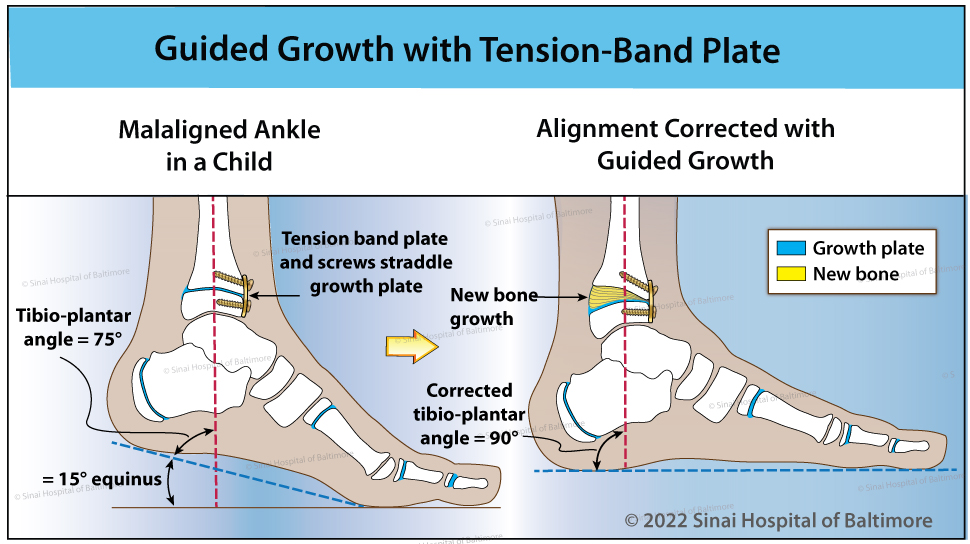 Medical illustration showing how guided growth is used to correct an ankle deformity