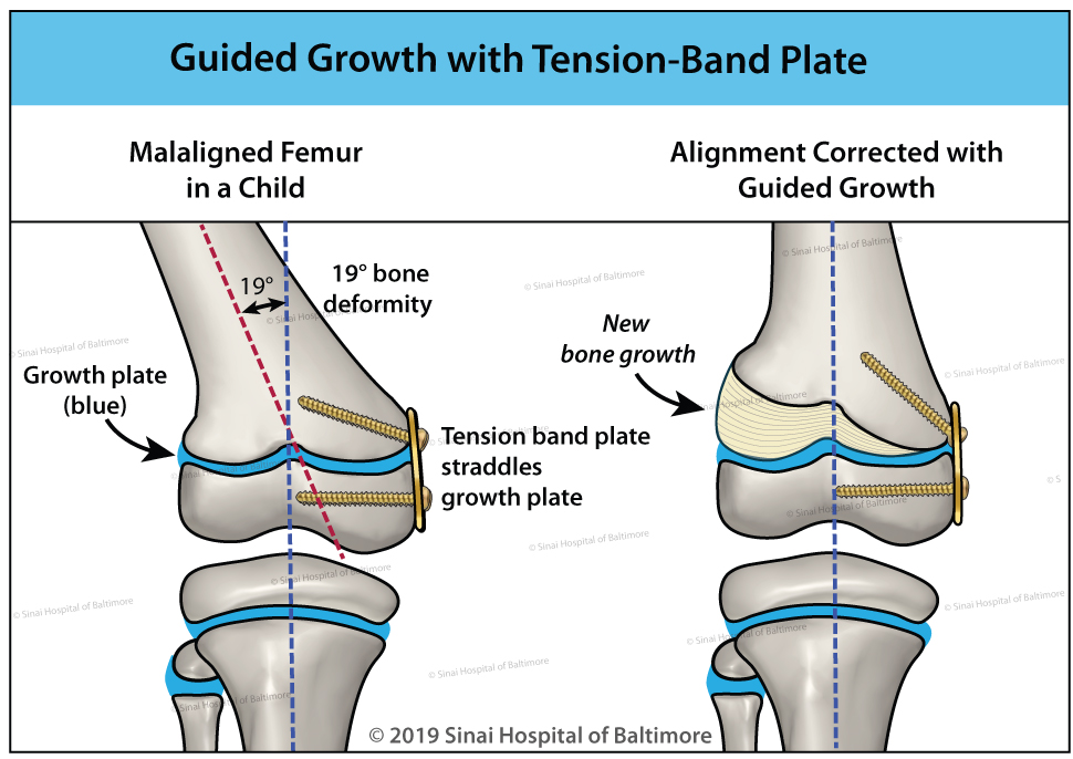 Illustration of guided growth using a tension-band plate