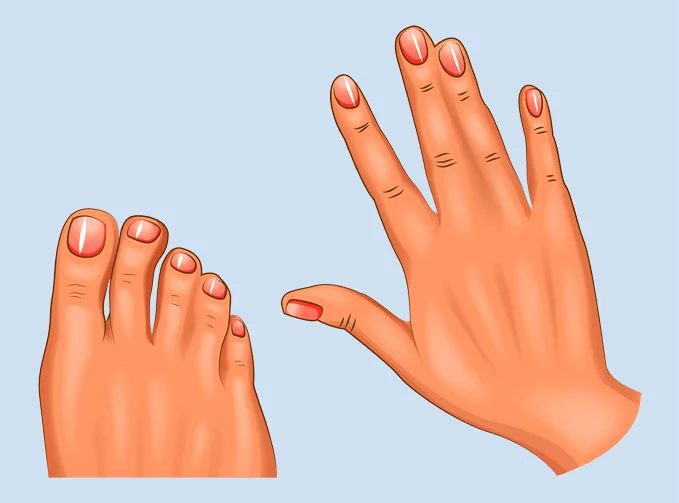 An illustration of a hand and foot with syndactyly showing webbed fingers and toes