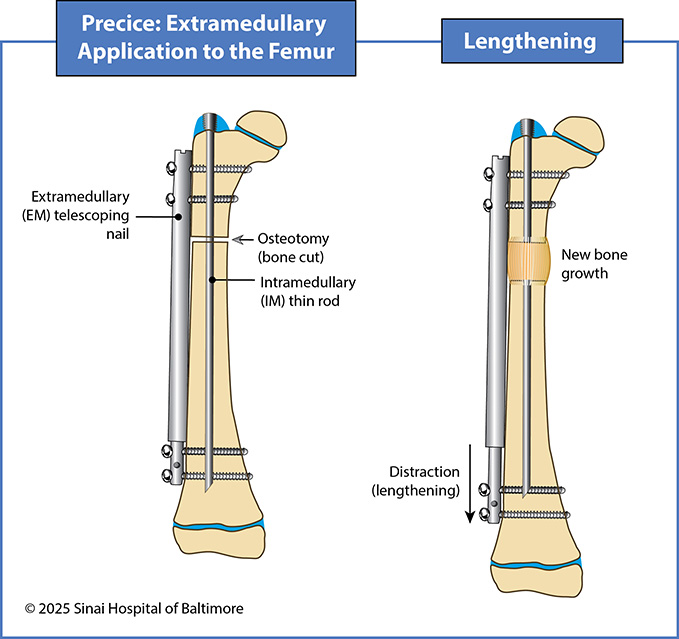 Illustration showing application and internal lengthening with an extramedullary Precice nail