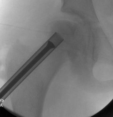 Intraoperative X-ray demonstrating bone grafting of femoral head after removal of necrotic bone
