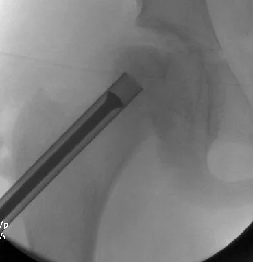 Intraoperative X-ray demonstrating bone grafting of femoral head after removal of necrotic bone