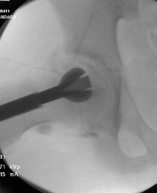 Intraoperative X-ray demonstrating removal of necrotic bone from a bone tunnel up the femoral neck