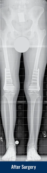 X-ray of a patient's legs with knock knees after acute corrective surgery on both legs, showing fixator-assisted plating of both femur bones.