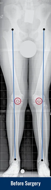 X-ray of a patient's legs with knock knees before surgery with lines drawn to indicate the misalignment of the knees.