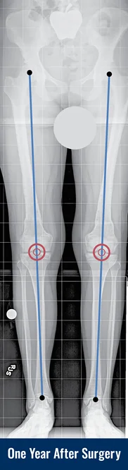 X-ray of a patient's legs with knock knees one year after surgery with lines drawn to indicate normal alignment.