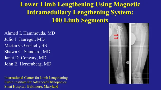 Research poster presented at the Annual Meeting of the American Orthopaedic Association in Charlotte, North Carolina in June 2017