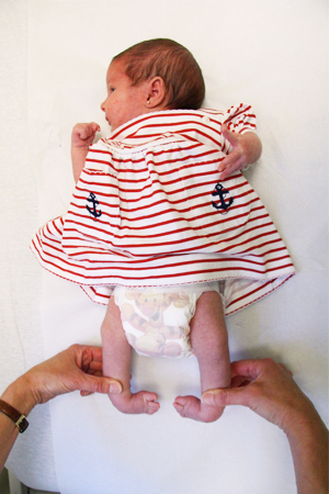 Luisa as a baby with bilateral clubfoot