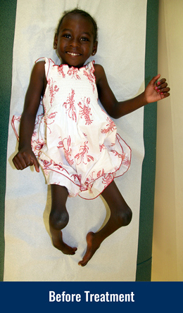 Melissa as a young child laying on an exam table with severe club feet and arthrgryposis