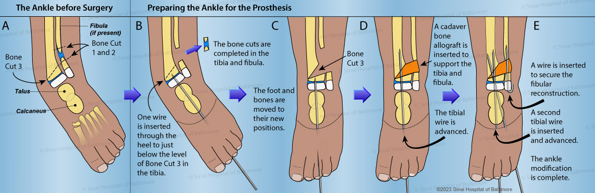 Illustration showing the steps of mini SUPERankle surgery, when the ankle is being prepared for the prosthesis
