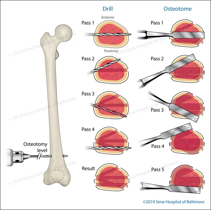 Illustration of a multiple drill-hole osteotomy technique for a corticotomy in the distal femur (near the knee). The drill is passed several times before an osteotome is used to complete the corticotomy.