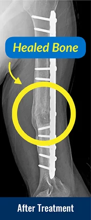 After x-ray showing healed bone from treatment for a forearm nonunion.