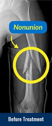 Before x-ray showing a forearm nonunion.