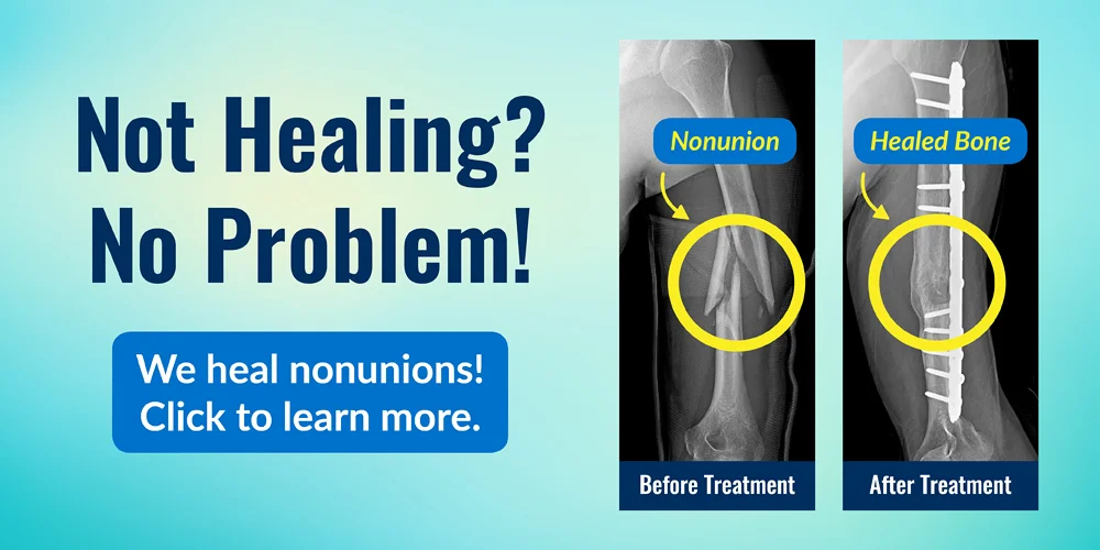 Not healing? No problem! The International Center for Limb Lengthening heals nonunions. Before and after x-rays showing healed bone from treatment for a forearm nonunion.