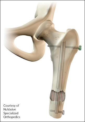 Illustration of the Precice Freedom Nail inside a femur. Courtesy of NuVasive Specialized Orthopedics.