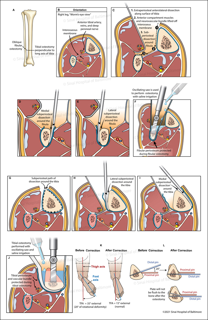 Illustrations describe a surgical procedure to improve the alignment of the lower limb with one unique trans-tibial incision to complete the osteotomies (bone cuts) in both the tibia and fibula.