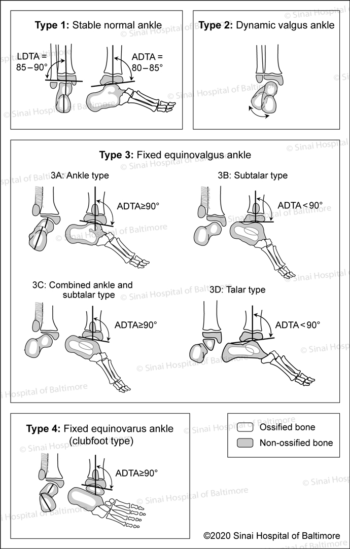 Paley Classification for Fibular Hemimelia: Type 1: Stable normal ankle; Type 2: Dynamic valgus ankle; Type 3: Fixed equiovalgus ankle, 3A Ankle type; 3B: subtalar type; 3C Combined ankle and subtalar type; 3D Talar type; Type 4: Fixed equinovalgus ankle (clubfoot type) 