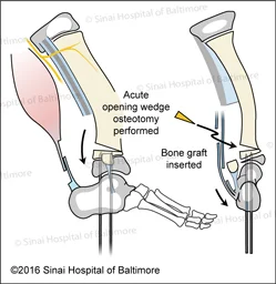 SUPERankle Surgical Technique for Supramalleolar Type Fibular Hemimelia (Paley Type 3A - ankle type). Acute opening wedge osteotomy performed. Bone graft is inserted.
