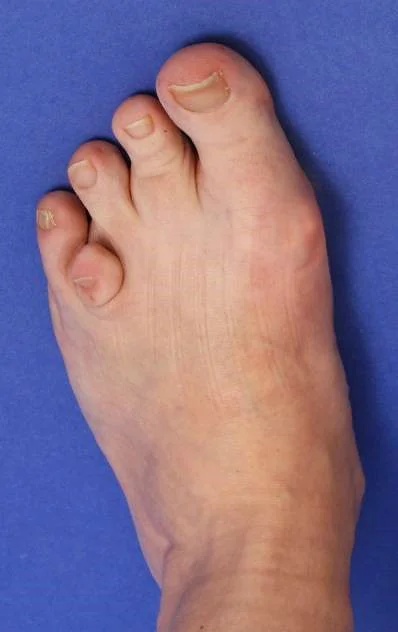 A patient's left foot with brachymetatarsia