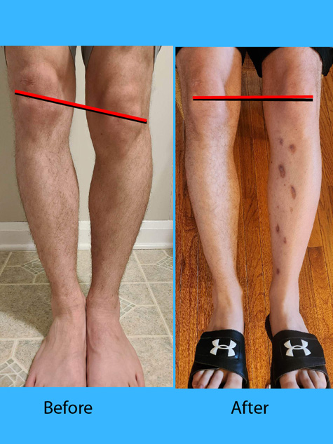 Andrew's leg before and after surgery