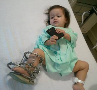 Aria as a young child lying down wearing an external fixator