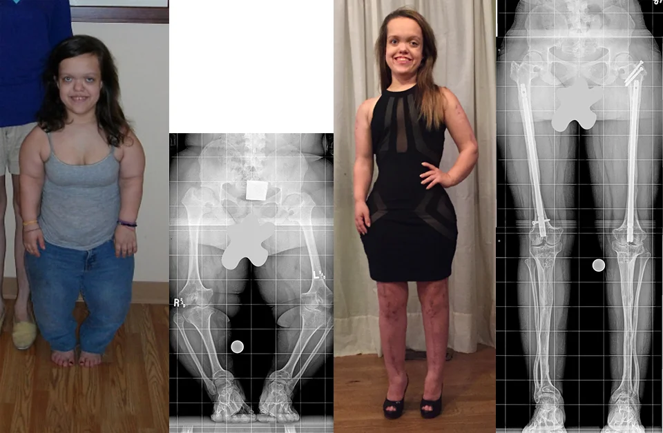 A set of four images: two photos and two x-rays of a female patient with achondroplasia. One picture is labeled 2010 and that picture and the first X-ray from her waist down show her before treatment. A second picture labeled 2015 depicts Chandler after completing treatment where she is significantly taller; the accompanying X-ray from the waist down post-treatment shows her dramatically longer and straighter legs.