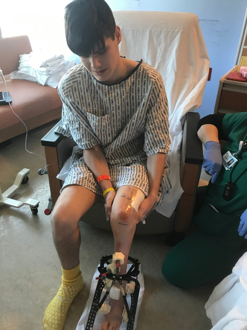 Jack in a hospital gown holding his leg that has an external fixator on it
