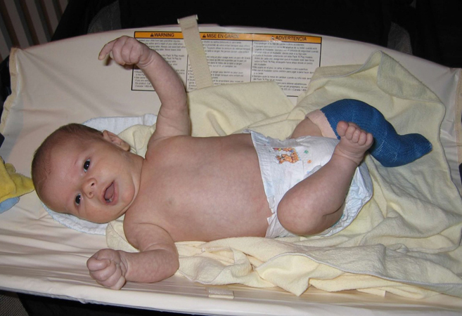 Jack as a baby with a cast on his leg