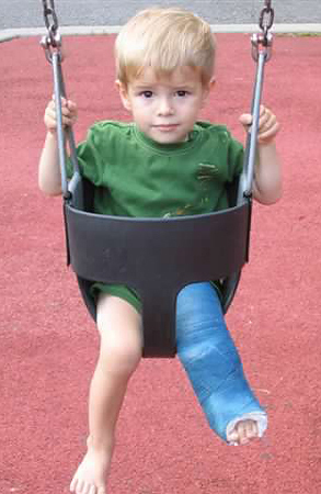 Jack as a small child sitting in a swing with a cast on his leg showing a noticeable limb length discrepancy