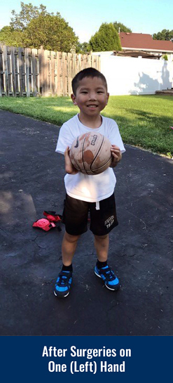 James playing with a basketball outside after having surgery on his left hand