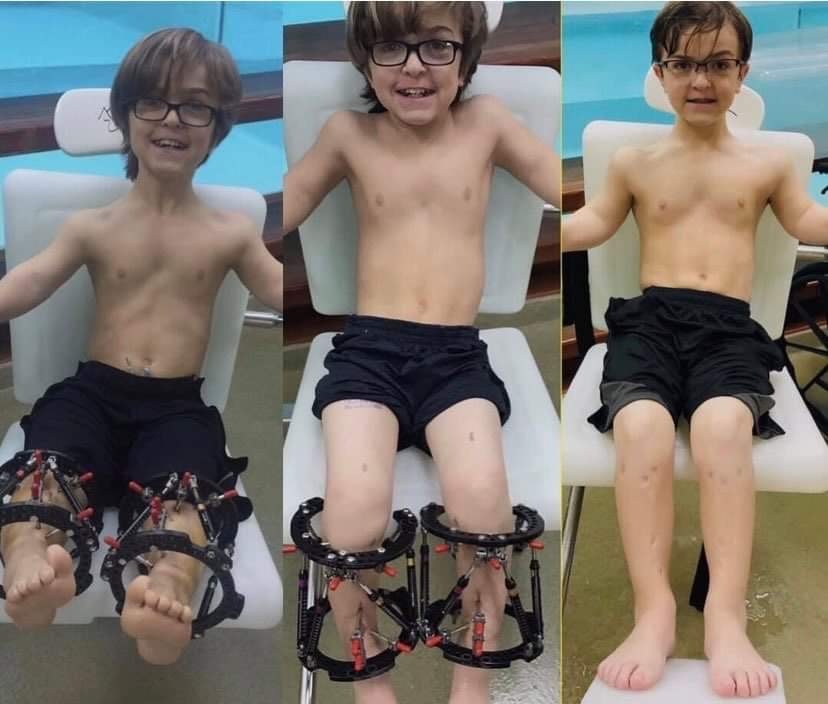 Preston in hydrotherapy before, during & after lengthening