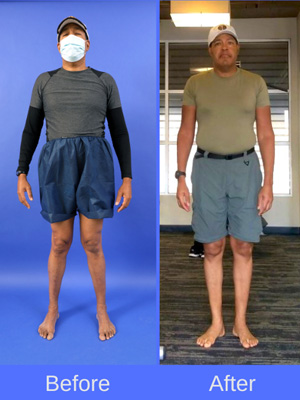 Sidney before and after surgical knock knee correction