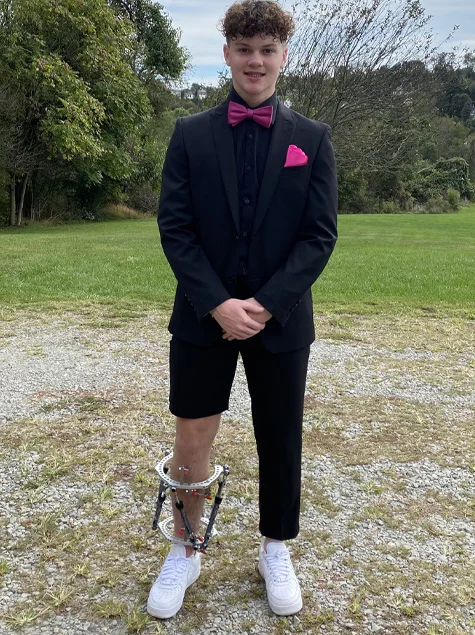 Thomas dressed up for a special event while wearing his external fixator