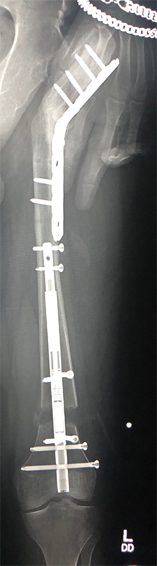 X-ray of Zackary’s femur showing internal fixation including a retrograde Precice internal lengthening nail