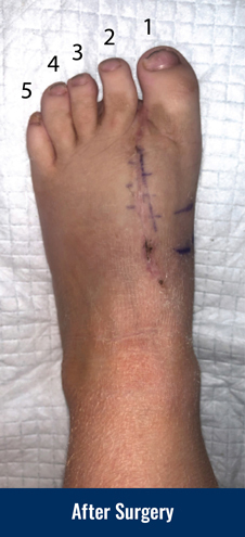 Color photo describing the condition and treatment of pediatric polydactyly of the foot: The same child after surgery to remove the extra toe. Toes 1 and 2 have been brought together to make a normal spacing between the toes. This gives a normal, pleasing appearance to the foot.