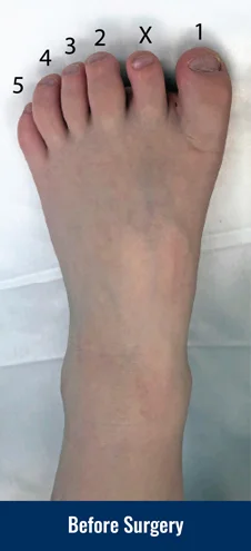Color photo describing the condition and treatment of pediatric polydactyly of the foot: Child born with 6 toes. The one labelled “X” is the extra toe that needs to be removed.