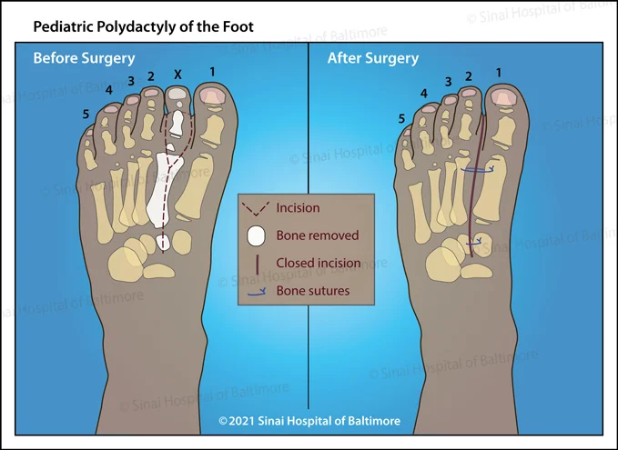Illustration of a foot before and after surgery to remove an extra toe in a pediatric patient who has polydactyly of the foot