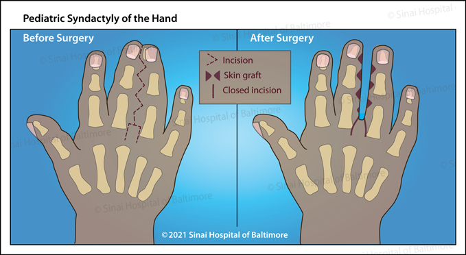 Illustration describing the condition and treatment of pediatric syndactyly of the hand