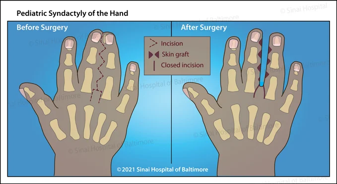 Illustration describing the condition and treatment of pediatric syndactyly of the hand