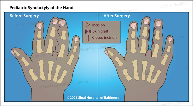 Syndactyly Baltimore MD International Center For Limb Lengthening