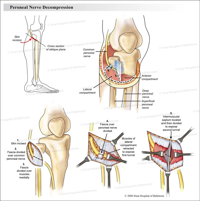 Peroneal nerve decompression illustrations in 5 figures: 1. Orientation with skin incision identified; 2. Structures are indentifed in an oblique crossection of the area of dissection including the common peroneal nerve, the anterior compartment, the lateral copartment, the deep peroneal nerve, and the superficial peroneal nerve; 3. Surgical steps 1: skin incised, 2. Fascia divided over common peroneal nerve, 4, Fascia over peroneal nerve divided,; muscles of lateral compartment retracted to expose first tunnel; 5. Intramuscular septum located and then divided to expose second tunnel.