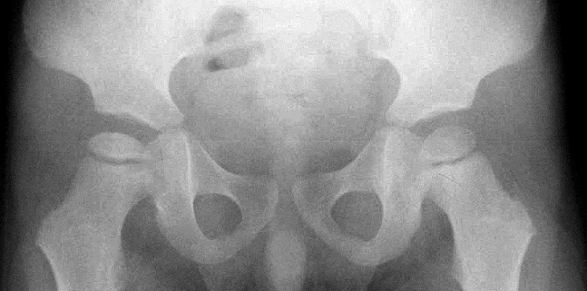 X-ray of human pelvis and femoral heads, showing Stage 2 (early collapse) of Perthes disease