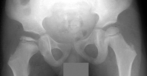 X-ray of human pelvis and femoral heads, showing Stage 4 (late collapse) of Perthes disease