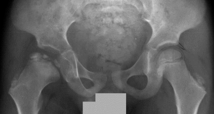 X-ray of human pelvis and femoral heads, showing Stage 6 (late fragmentation) of Perthes disease