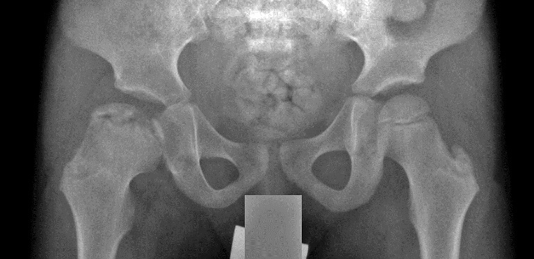 X-ray of human pelvis and femoral heads, showing Stage 7 (early reconstitution) of Perthes disease