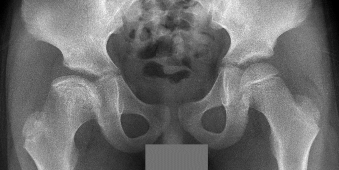 X-ray of human pelvis and femoral heads, showing Stage 9 (reconstituted) of Perthes disease